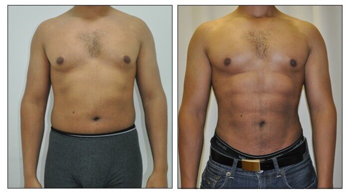 Before/after of ab implant plastic surgery.